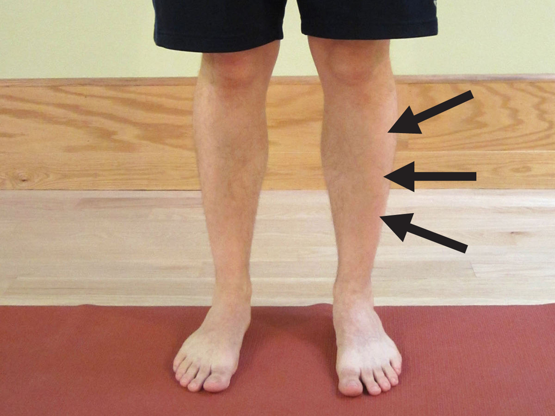 how-to-prevent-shin-splints-the-physical-therapy-advisor