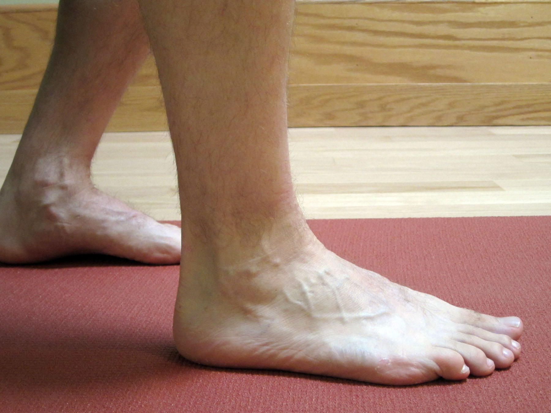 Голеностопный сустав левой ноги. Припухлость на щиколотке. Повреждения голеностопа ноги.
