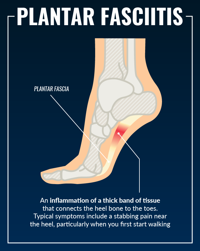 https://www.thephysicaltherapyadvisor.com/wp-content/uploads/2014/12/PlantarFasciitis_101217.png
