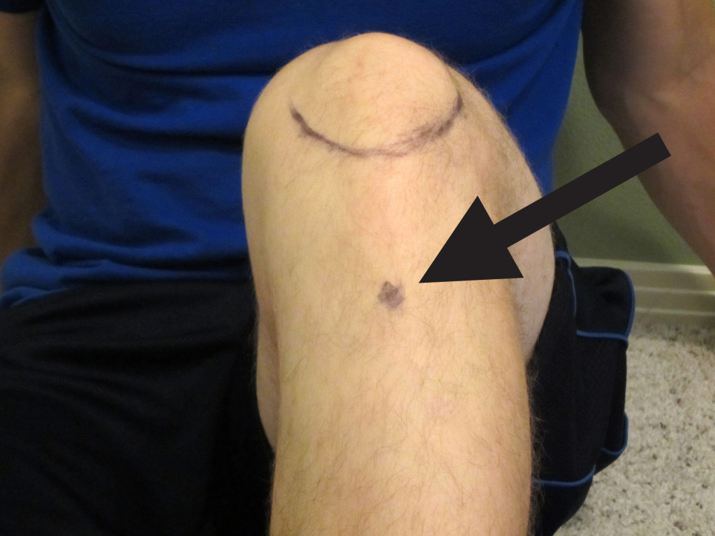 Q & A: My Top 5 Tips on How to Self-Treat Osgood-Schlatter Disease
