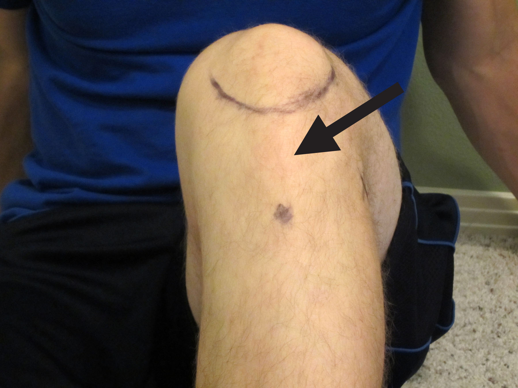 How to Self-Treat Patellar Tendon Pain with a Mobility Band