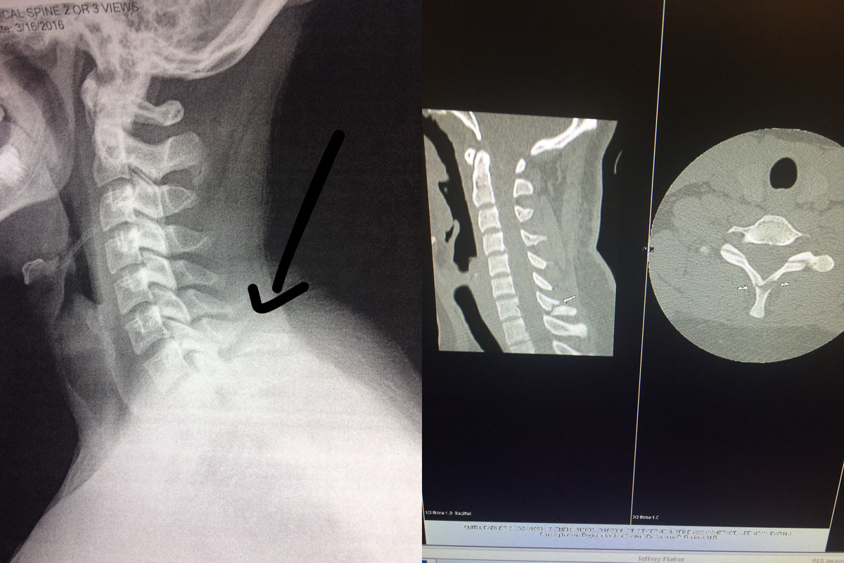 Q A Spinous Process Fracture The Physical Therapy Advisor