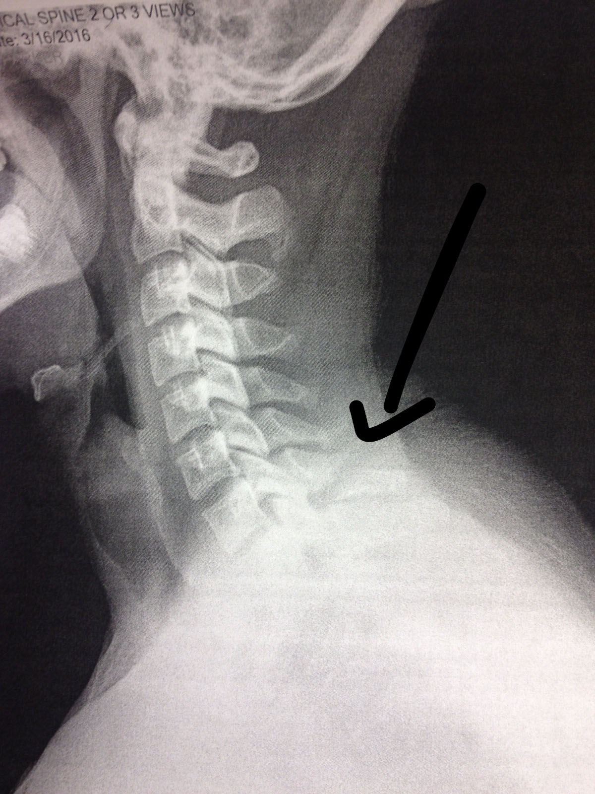 Spinous Process Fracture