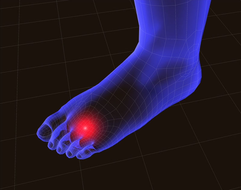 CALCANEAL FRACTURE RECOVERY FAQs: