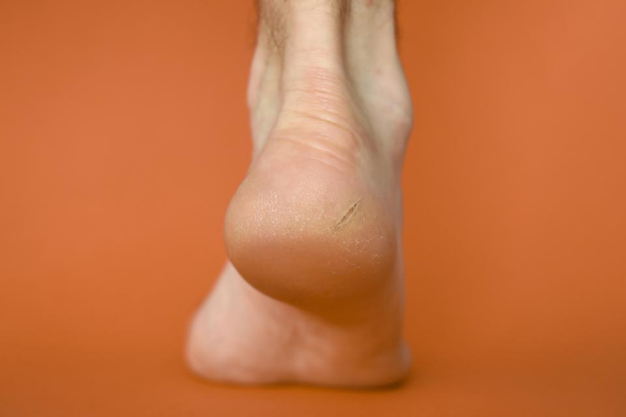 Cracked Heels' Causes, Treatment and Prevention